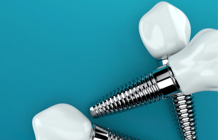 Dental Implant Over Denture & Bridges